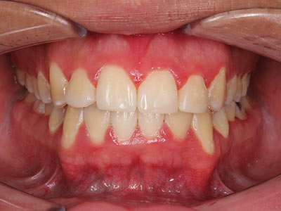 Before & After Orthodontic Pictures